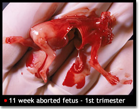 http://patrickandchristy.files.wordpress.com/2009/07/11-week-aborted-fetus1.jpg